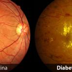 เบาหวานเข้าจอประสาทตา ( Diabetic Retinopathy )