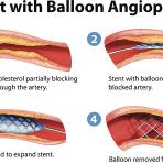 โรคหลอดเลือดแดงส่วนปลายอุดตันที่ขา  รักษาด้วยการขยายเส้นเลือดด้วยบอลลูน  ( Angioplasty for Peripheral Arterial Disease of the Legs )