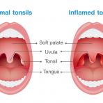 ทอนซิลอักเสบ ( Tonsillitis )